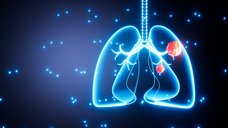 非喫煙者の肺がんに大気汚染の影響　NIHの大規模ゲノム研究