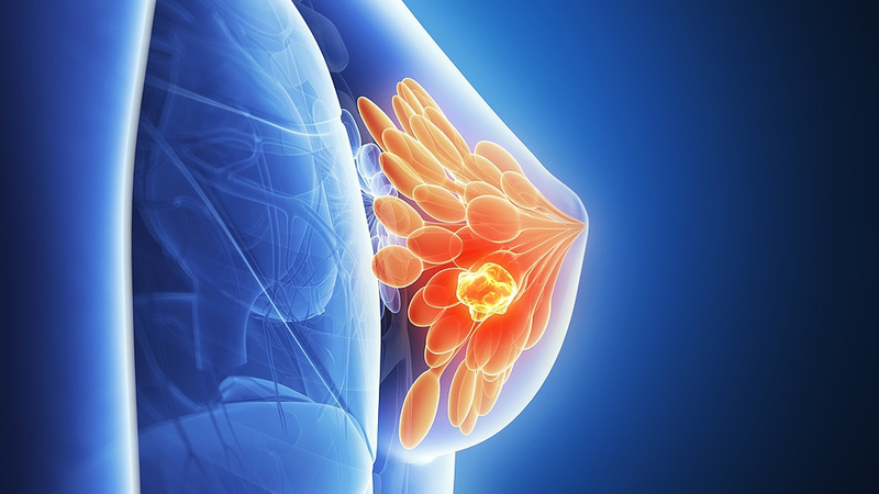 イスラエル研究チーム、乳がん細胞の「休眠」を解明　再発予防へのヒントに