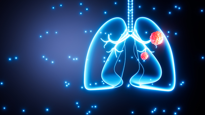 「非喫煙者の肺がん」が世界で最大2割に　国際研究レビュー