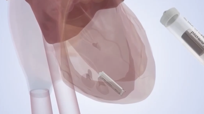 カプセルサイズの自己発電マイクロペースメーカー、中国研究チームが開発