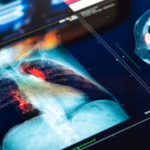 両肺を摘出後も48時間生存—「全人工肺」がつないだ二重肺移植への道