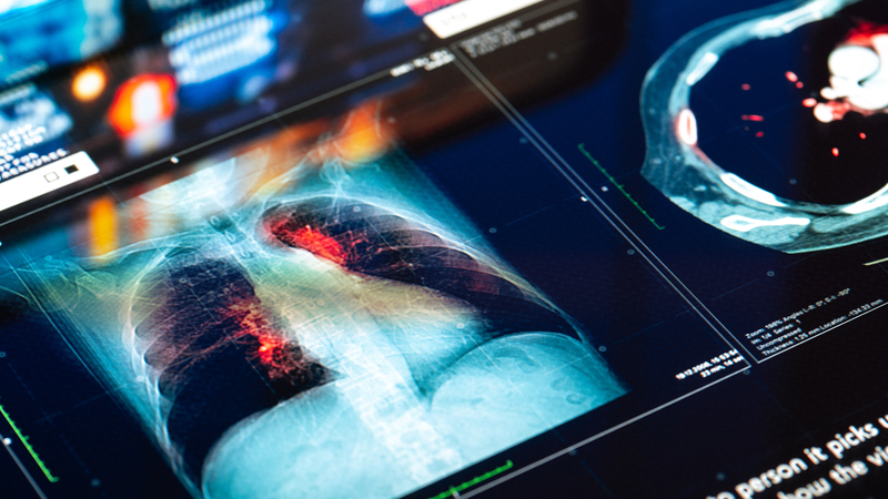両肺を摘出後も48時間生存—「全人工肺」がつないだ二重肺移植への道